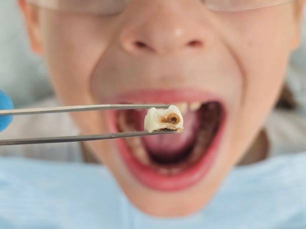 Best Dentist for Tooth Abscess  in Wyoming, OH